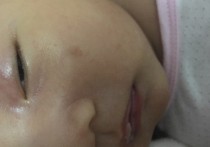 为什么小婴儿会长咖啡斑 1岁宝宝脸上长了一小块小块的黑斑怎么回事？
