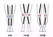 内八字是什么腿型图 内八字腿型是不是也叫o型腿