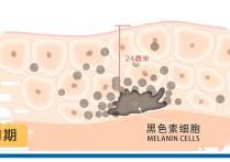 ?斑用什么麻药 激光祛斑需要打麻药吗？