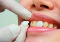 牙贴面用什么材质好 牙齿贴面材料有哪些?