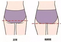 什么情况下胯会变大 胯骨越长越宽怎么办