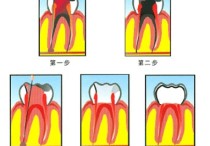 牙齿什么情况做根管 牙齿问题严重到什么地步需要进行根管治疗？