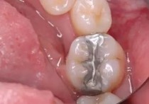 补牙用什么树脂材料好 补牙材料到底用什么好?