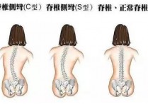 骨盆歪是什么引起的 怎样判断你是不是真的骨盆前倾呢