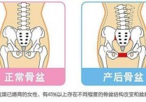 骨盘松弛 吃什么药 如何判断产后盆底肌恢复情况