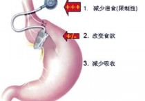 有什么办法让胃变小 怎么减小自己的胃