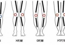 练什么动作改变x型腿 x型腿矫正训练方法图解