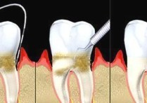 牙周病什么症状 牙龈炎牙周炎吃什么药