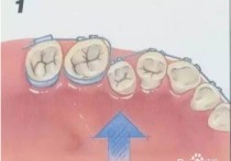 矫正牙齿的原理是什么 牙齿矫正的原理？牙齿不是连接在骨头上面吗