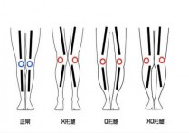 xo型腿是什么样的 x型腿图解