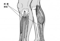 快走为什么小腿前边痛 小腿前面一走路就疼不走就不疼