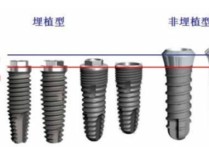 dio种植什么价格 韩国种植牙奥齿泰，登腾，DIO有什么区别