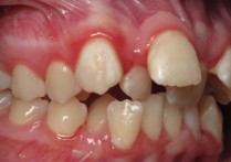牙齿矫正前为什么拔牙 牙齿矫正为什么还要拔牙？