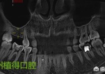 植牙前为什么要洗牙 种植牙手术过程是怎样的