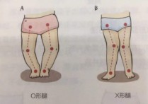 健康腿是什么样的图片 o型腿和八字腿图片对比