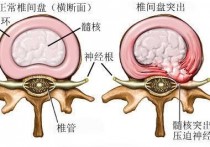 练腹肌对腰椎有什么影响 腰间盘突出腹部训练